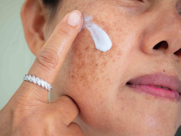Tiêu chí lựa chọn kem trị nám hiệu quả