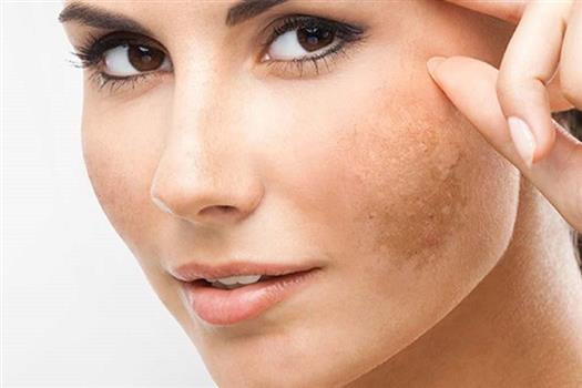 VÌ SAO PHỤ NỮ CHÂU Á HAY BỊ NÁM? LÀM SAO ĐỂ HẠN CHẾ NÁM PHÁT TRIỂN