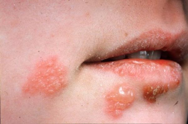 Bệnh da do virus