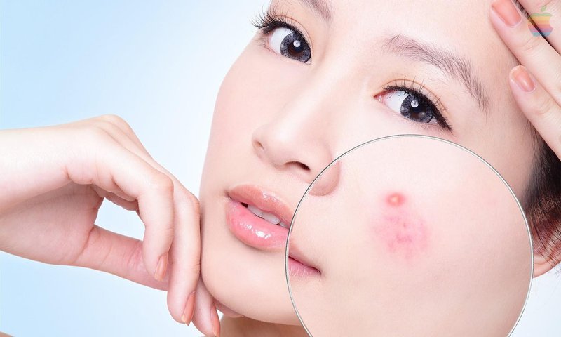 Điều trị trứng cá và sẹo mụn