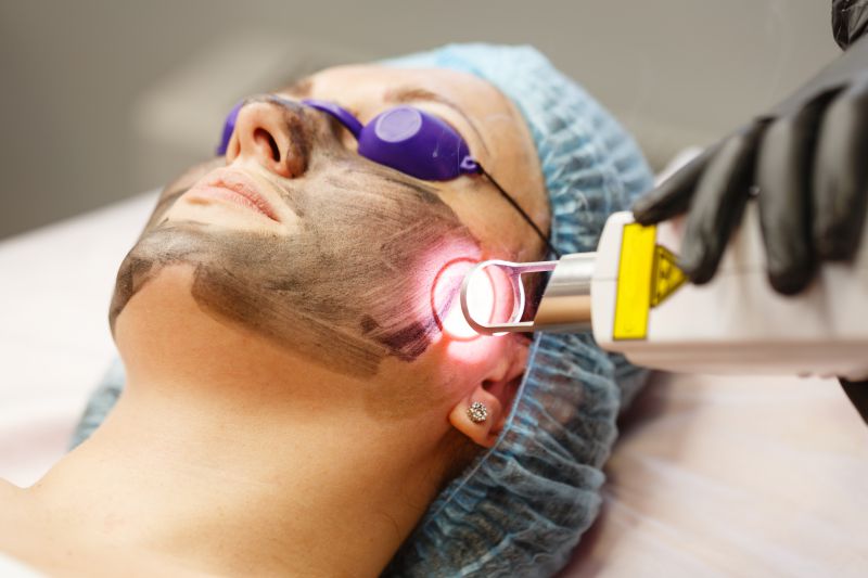 Laser than hoạt tính trị mụn