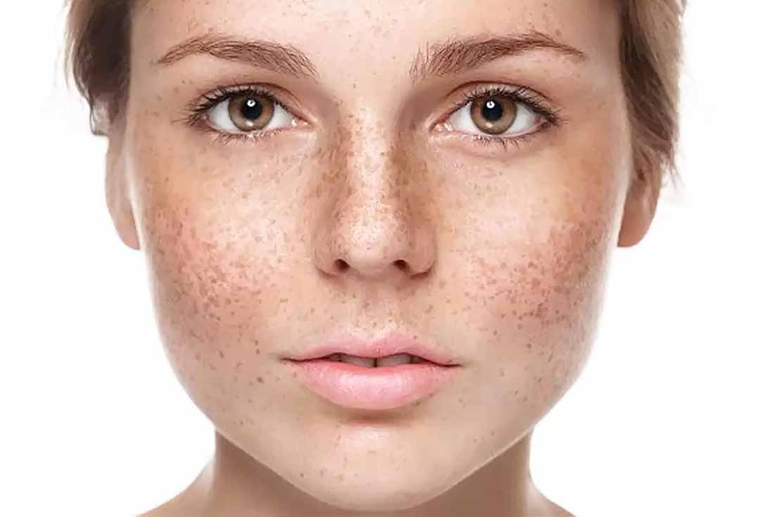Điều trị rám má, tăng sắc tố da