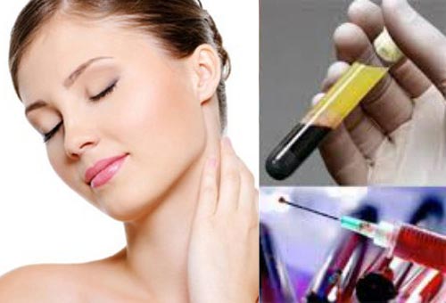 PRP điều trị rám má