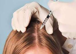Tiêm vi điểm (mesotherapy) điều trị rụng tóc từng mảng bằng Triamcinolon