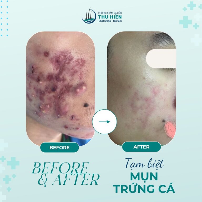 NGHE THEO REVIEW SẢN PHẨM TRỊ MỤN THẦN THÁNH, BẠN H 