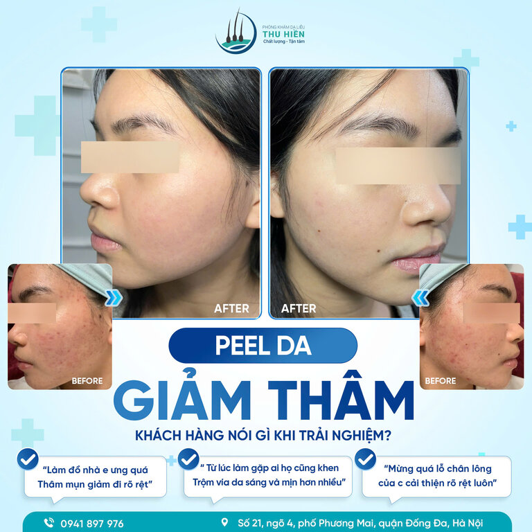 PEEL DA GIẢM THÂM – KHÁCH HÀNG NÓI GÌ SAU KHI TRẢI NGHIỆM?