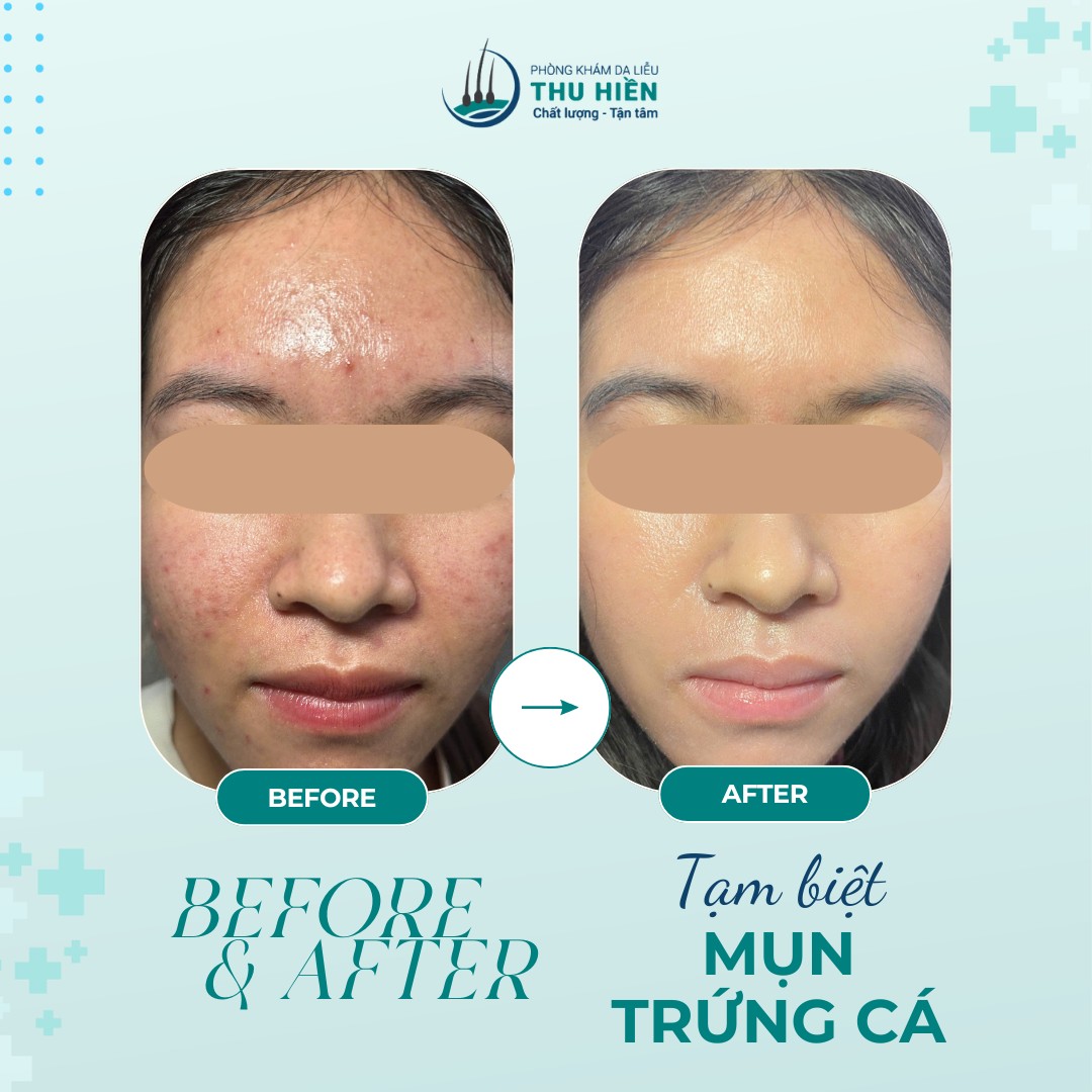 CASE THỰC TẾ | Sự khác biệt rõ rệt giữa #buổi_1 và #buổi_5 của liệu trình