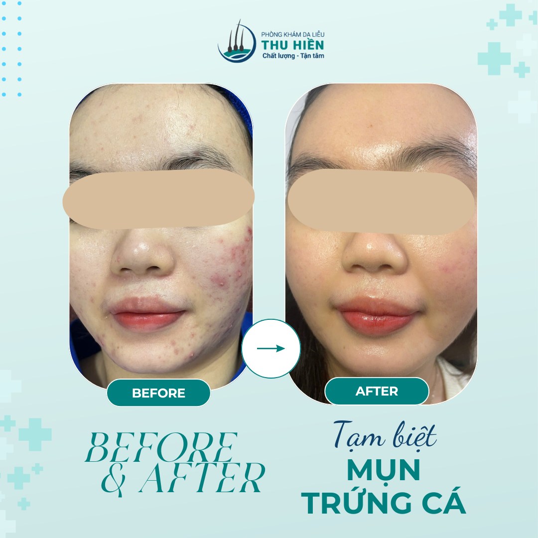 CASE THỰC TẾ | Sự khác biệt rõ rệt giữa #buổi_1 và #buổi_5 của liệu trình