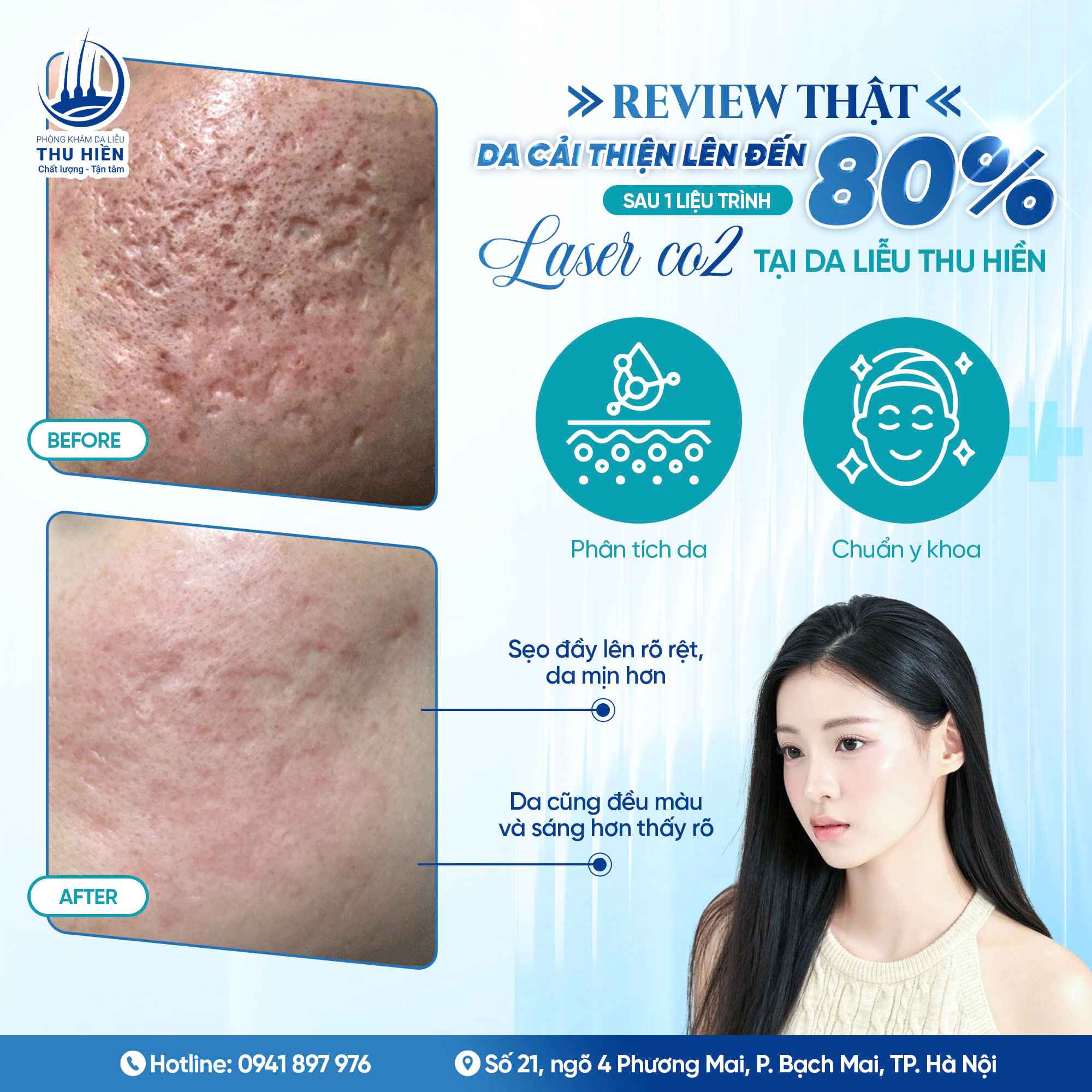 [𝐑𝐄𝐕𝐈𝐄𝐖 𝐓𝐇𝐀̣̂𝐓] Từng điều trị s.ẹo rỗ 1 năm không tiến triển