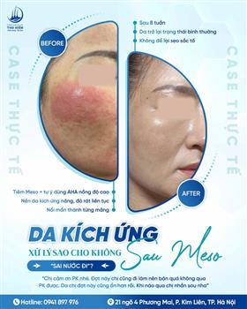 DA KÍ.CH ỨN.G SAU #MESO – XỬ LÝ SAO CHO KHÔNG “SAI NƯỚC ĐI”?