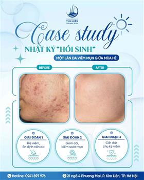 [CASE STUDY] NHẬT KÝ “HỒI SINH” MỘT LÀN DA VIÊM MỤN GIỮA MÙA HÈ