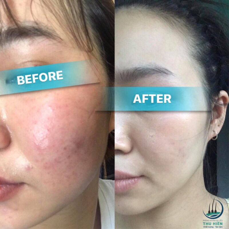 VIÊM DA DO DEMODEX TRƯỚC VÀ SAU ĐIỀU TRỊ