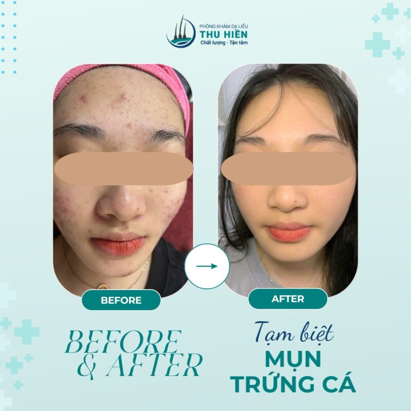 Sự khác biệt rõ rệt giữa #buổi_1 và #buổi_5 của liệu trình