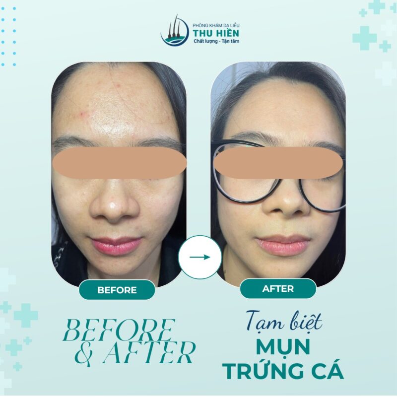 CASE THỰC TẾ | Sự khác biệt rõ rệt giữa #buổi_1 và #buổi_5 của liệu trình