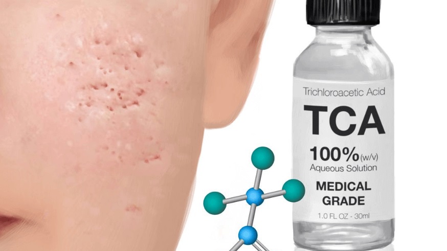 Acid TCA nồng độ cao tạo tổn thương giả, kích thích đáy sẹo đẩy mô thịt lên