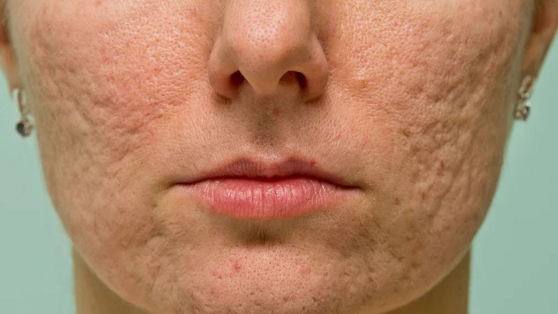 Tình trạng sẹo đáy nhọn (Ice pick scars) là gì?