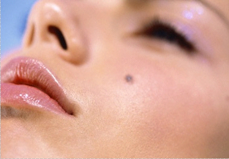 Công nghệ Laser CO2 giúp xóa bỏ tổn thương da chính xác, không gây chảy máu