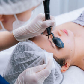 Tia laser hóa hơi mô bệnh lý một cách chính xác mà không làm tổn thương da lành