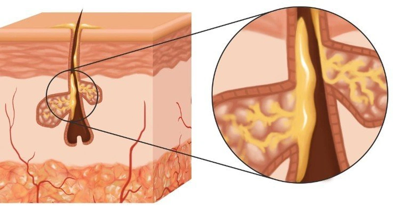 Tình trạng tăng tiết bã nhờn và lỗ chân lông to là gì?