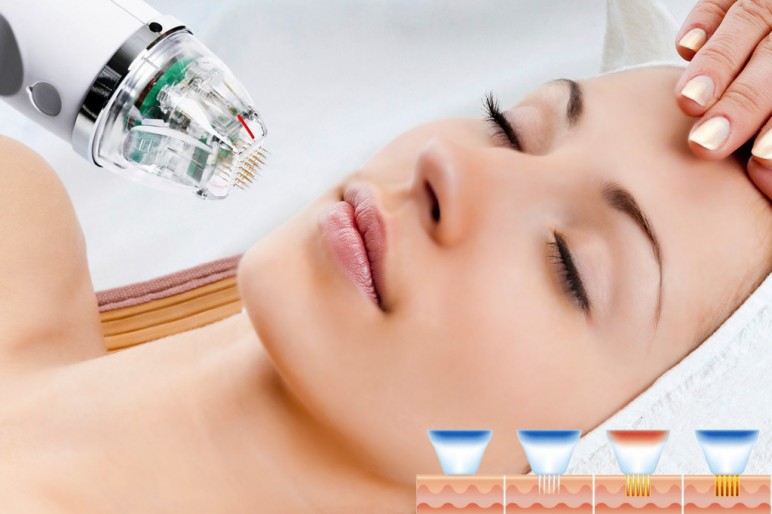 Năng lượng sóng vô tuyến đi sâu vào trung bì giúp tái tạo màng Collagen