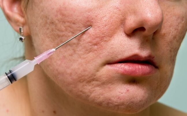 Trực tiếp Bác sĩ Da liễu thực hiện kỹ thuật bóc tách sẹo trong môi trường vô khuẩn
