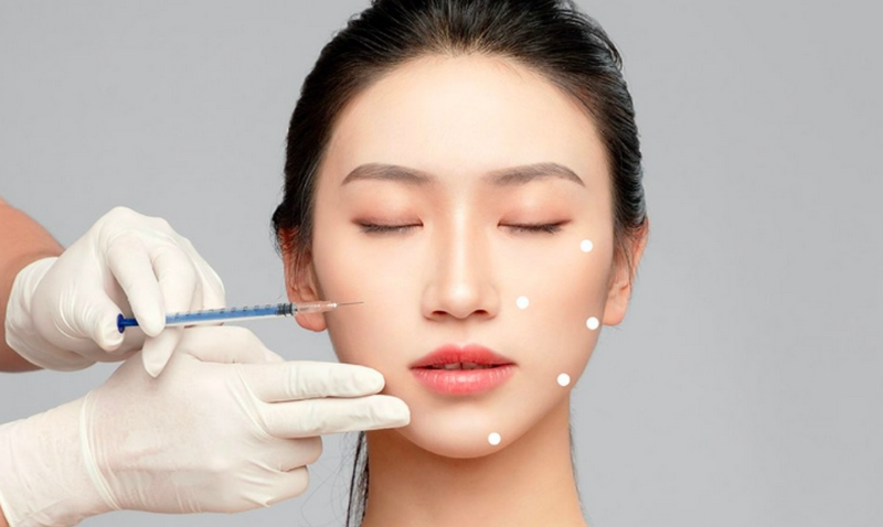 Kỹ thuật tiêm 5 điểm sinh học giúp HA nồng độ cao tự động lan tỏa đều khắp mặt
