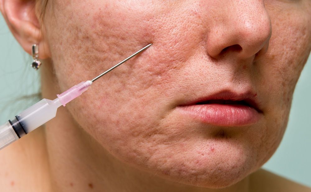 Tinh chất tăng trưởng kích hoạt mạnh mẽ quá trình tổng hợp Collagen tự thân