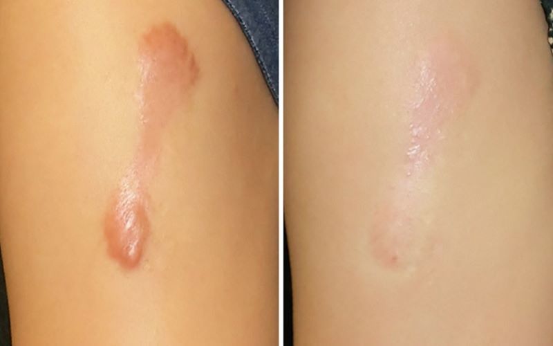 Ưu điểm nổi bật khi tiêm trị sẹo lồi tại Da liễu Thu Hiền