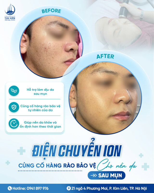 ĐIỆN CHUYỂN ION: CỦNG CỐ HÀNG RÀO BẢO VỆ CHO NỀN DA SAU M.ỤN