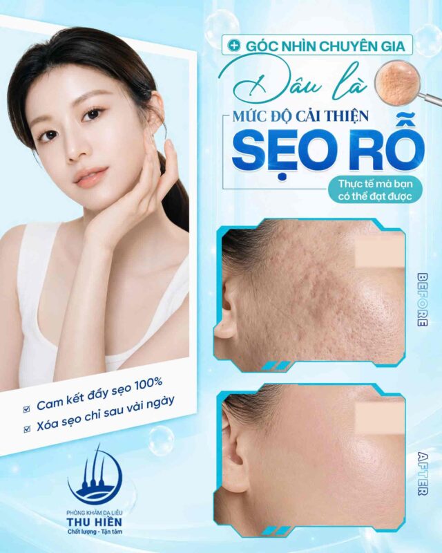 [GÓC NHÌN CHUYÊN GIA] 🔎 ĐÂU LÀ MỨC ĐỘ CẢI THIỆN #SẸO_RỖ THỰC TẾ MÀ BẠN CÓ THỂ ĐẠT ĐƯỢC?
