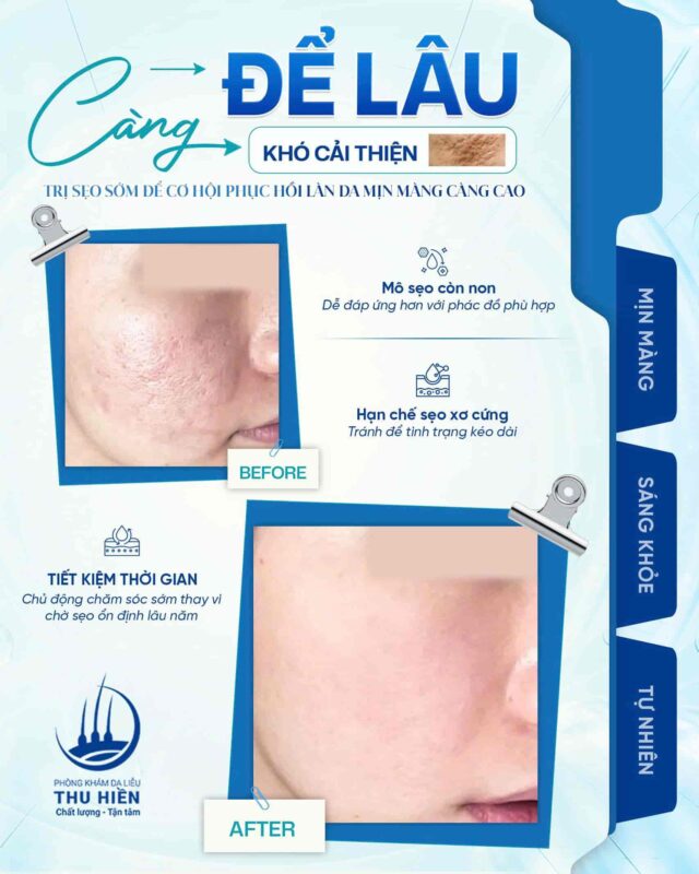CÀNG ĐỂ LÂU – CÀNG KHÓ CẢI THIỆN 📣 Trị s.ẹo sớm để cơ hội phục hồi LÀN DA MỊN MÀNG càng cao