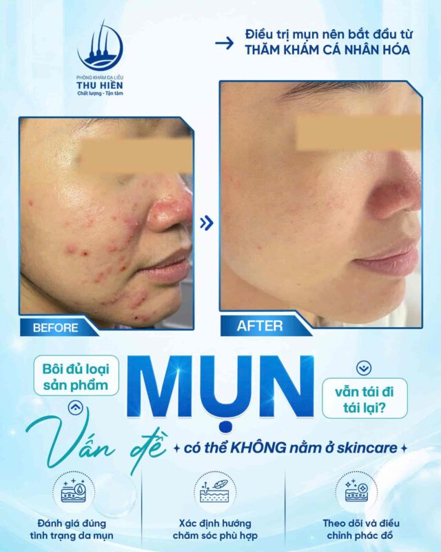 Bôi đủ loại sản phẩm nhưng m.ụn vẫn tái đi tái lại?  ➤ Vấn đề có thể KHÔNG nằm ở skincare