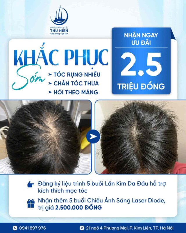 TÓC RỤNG NHIỀU, CHÂN TÓC THƯA DẦN, HÓI THEO MẢNG?  🎁 ĐĂNG KÝ KHẮC PHỤC SỚM → NHẬN NGAY ƯU ĐÃI 2,5 TRIỆU ĐỒNG 