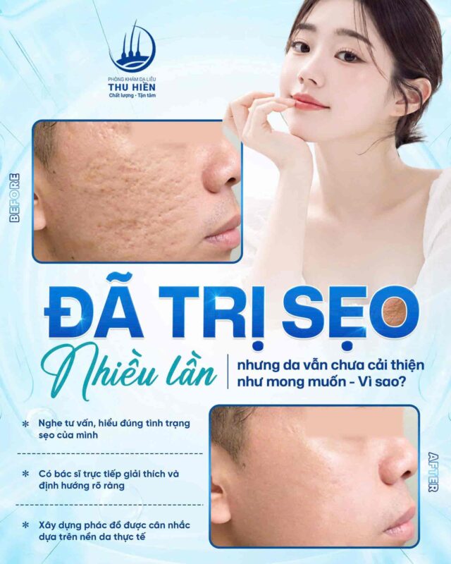 Đã trị s.ẹo nhiều lần nhưng da vẫn chưa cải thiện như mong muốn – Vì sao?